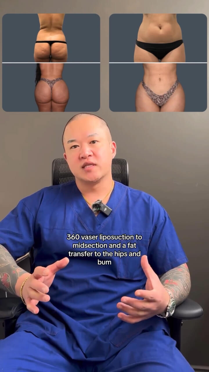 Another Fat Transfer to Buttocks Surgical Explanation