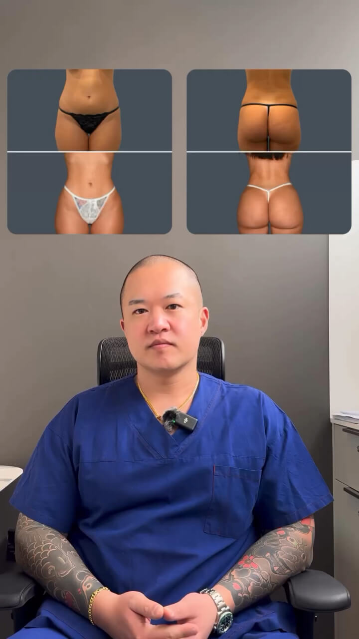 Fat Transfer to Buttocks Surgical Explanation